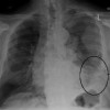 L’immunoth&#233;rapie am&#233;liore la survie des patients atteints de m&#233;soth&#233;liome et de cancer du poumon